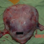 Autopsy of pregnant woman