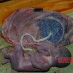 Autopsy of pregnant woman