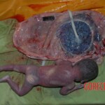 Autopsy of pregnant woman