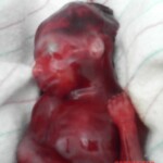 aborted fetus