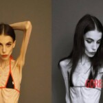 Anorexia