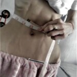 Anorexia