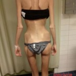 Anorexia