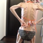 Anorexia