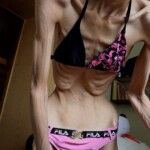 Anorexia