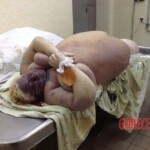 Autopsy of obese woman