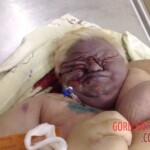 Autopsy of obese woman