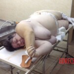 Autopsy of obese woman