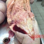 Autopsy of obese woman