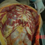 Dead drugged pregnant woman