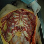 Dead drugged pregnant woman