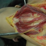 Dead drugged pregnant woman