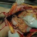 Dead drugged pregnant woman