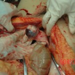 Dead drugged pregnant woman