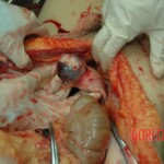 Dead drugged pregnant woman