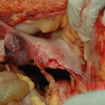 Dead drugged pregnant woman