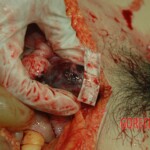 Dead drugged pregnant woman