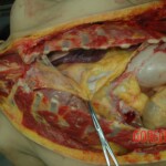 Dead drugged pregnant woman