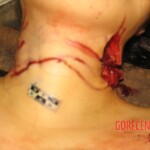 Raped and stabbed girl