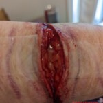 Self-harm wound