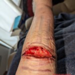 Self-harm wound