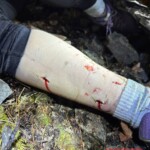 Bear attack in Slovakia