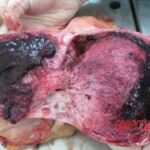 Obstetric complications