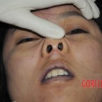 Examination of female corpse