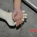 Examination of female corpse