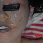 Suicide by poisoning