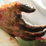 4th degree hand burn