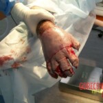 4th degree hand burn
