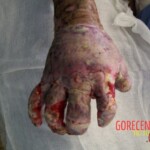 4th degree hand burn