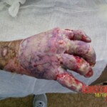4th degree hand burn