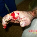 4th degree hand burn