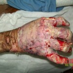 4th degree hand burn