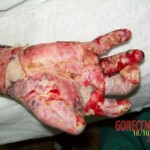 4th degree hand burn
