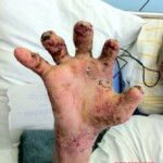 4th degree hand burn