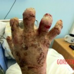 4th degree hand burn