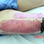 4th degree hand burn