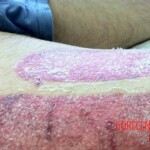 4th degree hand burn