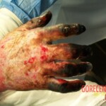4th degree hand burn