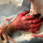 4th degree hand burn