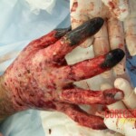 4th degree hand burn