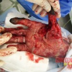 4th degree hand burn