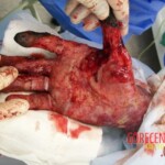 4th degree hand burn