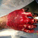 4th degree hand burn