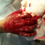 4th degree hand burn