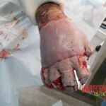 4th degree hand burn