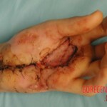 Rattlesnake bite